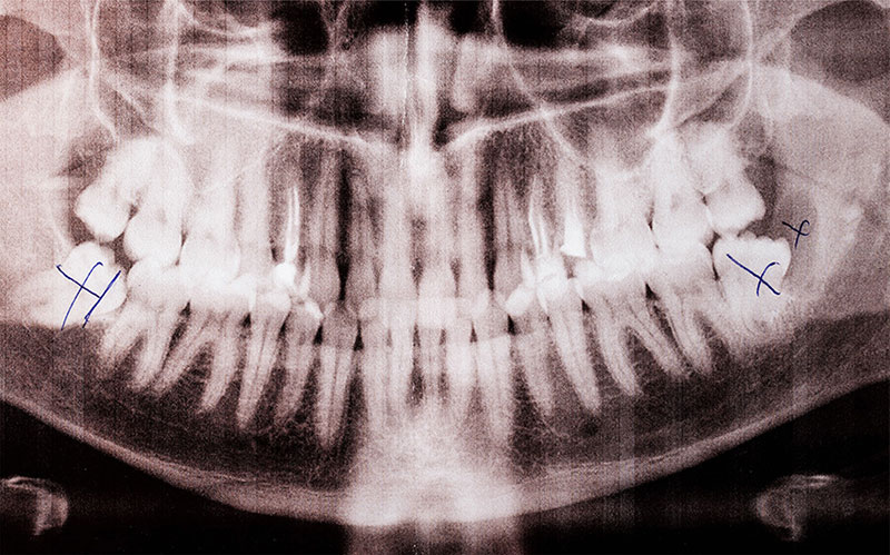 A diagnostic panoramic dental X-ray at River Ridge Oral & Maxillofacial Surgical Center, showing marked areas for wisdom teeth removal or identifying potential sites for dental implant surgery to restore a patient's oral health in Sioux Falls.