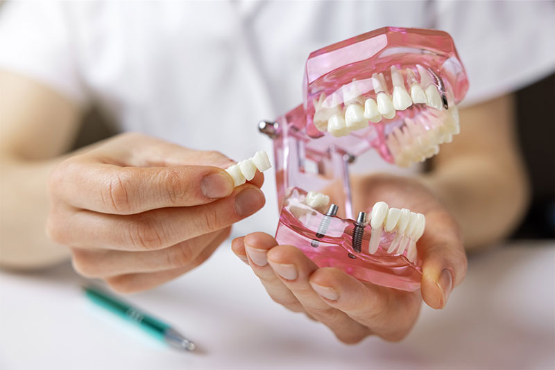 An expert at River Ridge Oral & Maxillofacial Surgical Center utilizing a dental prosthetic model to demonstrate the fit and function of implant-supported dentures during a patient consultation.